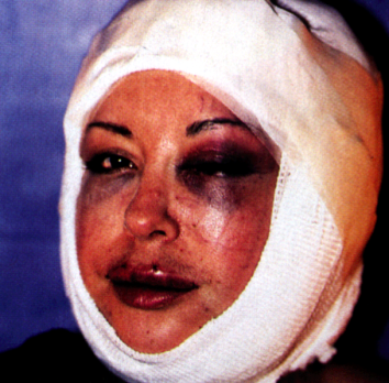 ORLAN, in bandages several days after her surgery ORLAN, in bandages several days after her surgery